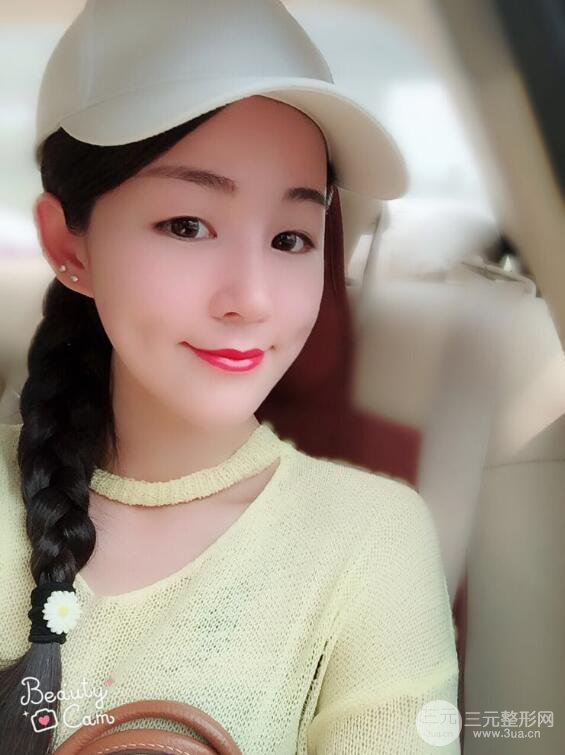 杭州华山连天美高俊明假体隆鼻术前术后对比图 两个月恢复心情