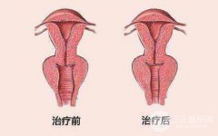 成都阴道紧缩术多少钱，影响价格因素有哪些