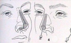 驼峰鼻矫正价钱?驼峰鼻矫正手术的费用是多少?