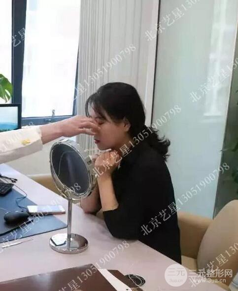 北京艺星仇侃敏微创肋软骨隆鼻前后对比图 术后一个月的恢复状况