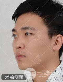 欧阳春双眼皮前后对比图 男孩子割双眼皮一样好看