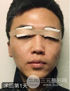 欧阳春双眼皮前后对比图 男孩子割双眼皮一样好看