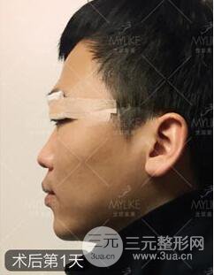 欧阳春双眼皮前后对比图 男孩子割双眼皮一样好看