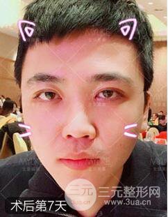 欧阳春双眼皮前后对比图 男孩子割双眼皮一样好看