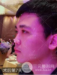 欧阳春双眼皮前后对比图 男孩子割双眼皮一样好看