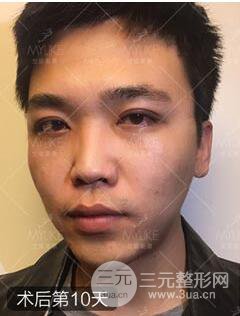 欧阳春双眼皮前后对比图 男孩子割双眼皮一样好看