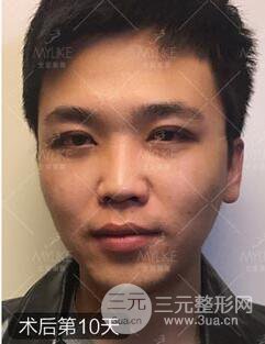 欧阳春双眼皮前后对比图 男孩子割双眼皮一样好看