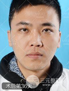 欧阳春双眼皮前后对比图 男孩子割双眼皮一样好看