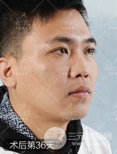 欧阳春双眼皮前后对比图 男孩子割双眼皮一样好看