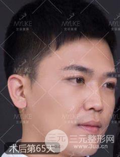 欧阳春双眼皮前后对比图 男孩子割双眼皮一样好看