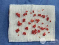 骨f隆鼻有哪些后遗症？骨f隆鼻的后遗症大不大？