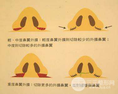 深圳缩鼻头手术大概多少钱 缩鼻头果如何