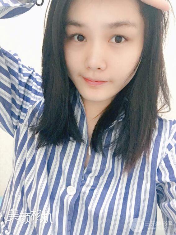 上海薇琳顾陆健韩式隆鼻前后对比图|真人案例心情日记