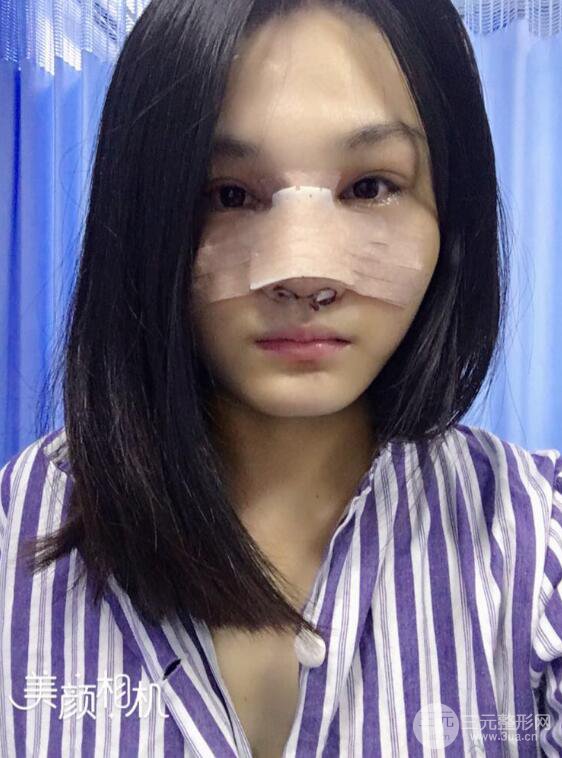 上海薇琳顾陆健韩式隆鼻前后对比图|真人案例心情日记