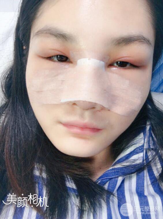 上海薇琳顾陆健韩式隆鼻前后对比图|真人案例心情日记