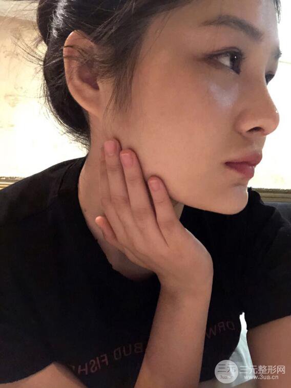 上海薇琳顾陆健韩式隆鼻前后对比图|真人案例心情日记