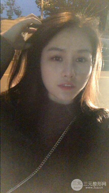 上海薇琳顾陆健韩式隆鼻前后对比图|真人案例心情日记