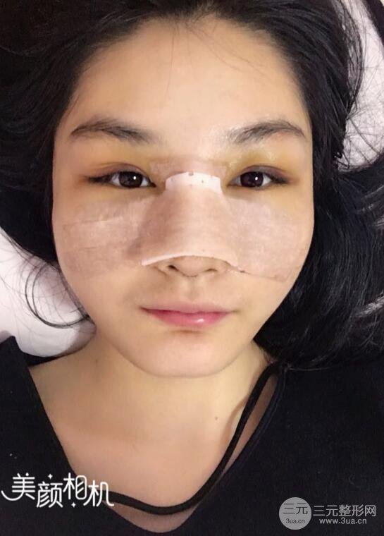 上海薇琳顾陆健韩式隆鼻前后对比图|真人案例心情日记