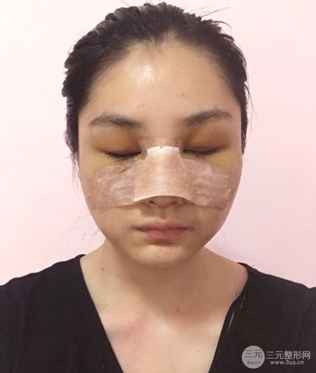 上海薇琳顾陆健韩式隆鼻前后对比图|真人案例心情日记