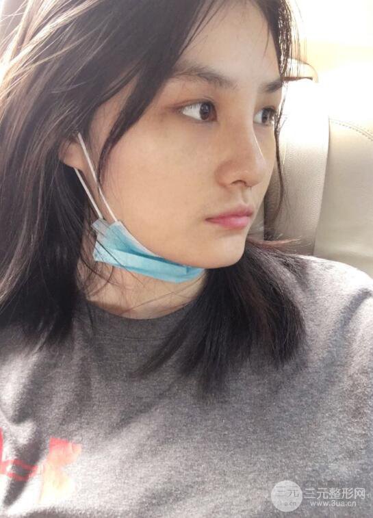 上海薇琳顾陆健韩式隆鼻前后对比图|真人案例心情日记