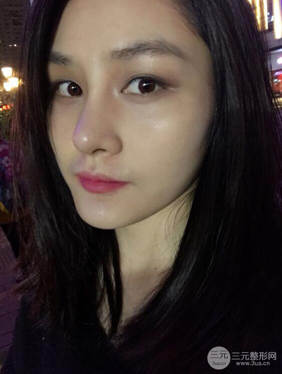 上海薇琳顾陆健韩式隆鼻前后对比图|真人案例心情日记