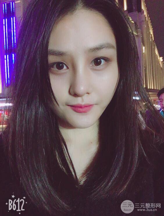 上海薇琳顾陆健韩式隆鼻前后对比图|真人案例心情日记