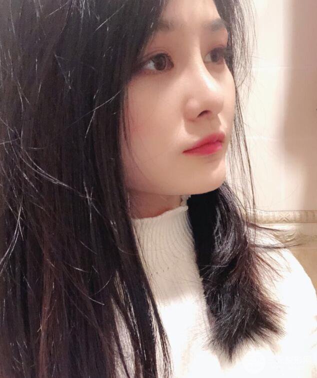 上海薇琳顾陆健韩式隆鼻前后对比图|真人案例心情日记