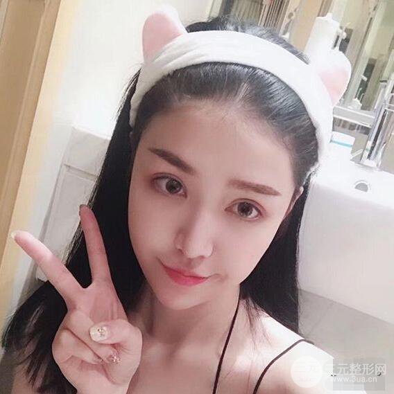 延吉金光善眼部整形失败修复前后对比图 三个月恢复自然