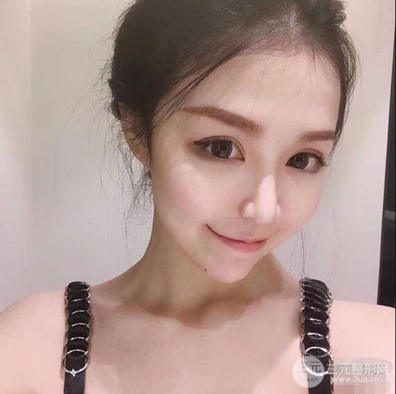 延吉金光善眼部整形失败修复前后对比图 三个月恢复自然