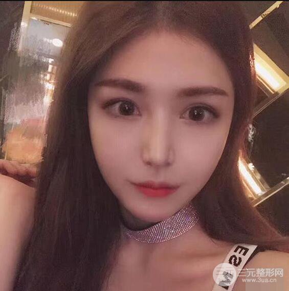 延吉金光善眼部整形失败修复前后对比图 三个月恢复自然