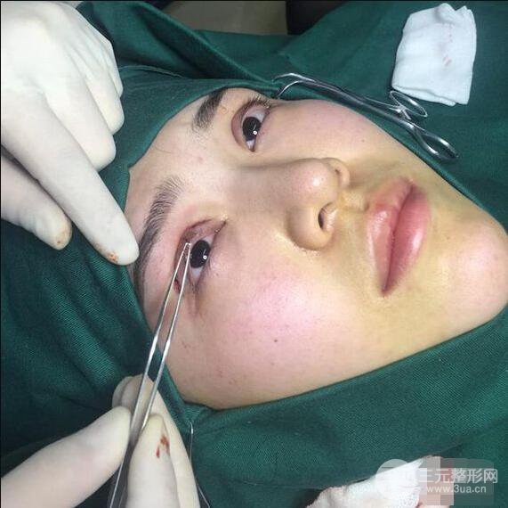 延吉金光善眼部整形失败修复前后对比图 三个月恢复自然