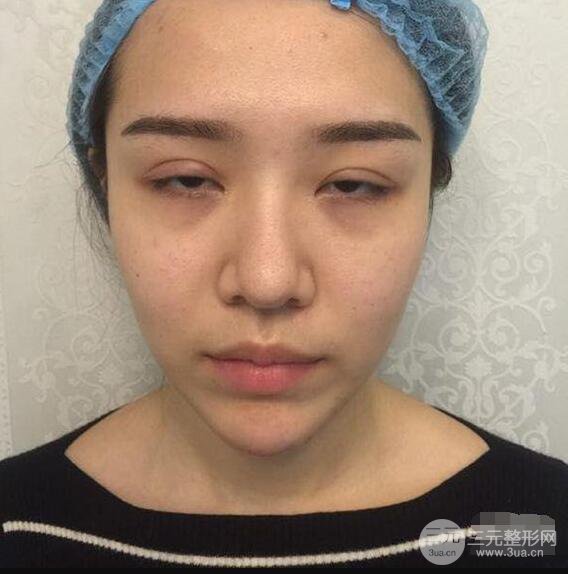延吉金光善眼部整形失败修复前后对比图 三个月恢复自然