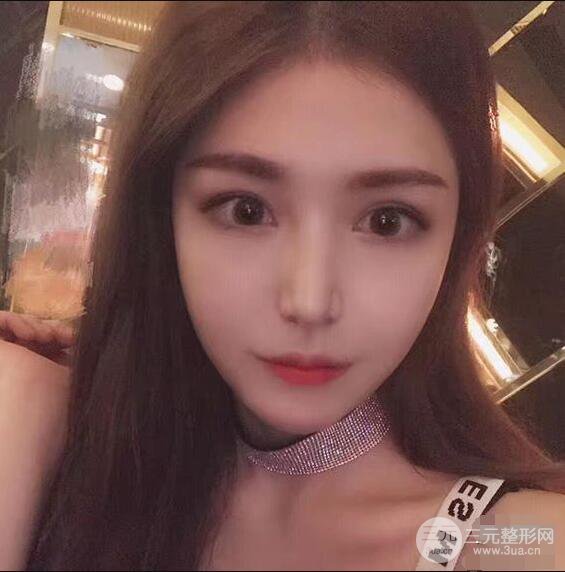 延吉金光善眼部整形失败修复前后对比图 三个月恢复自然