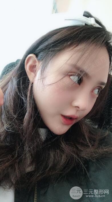 北京美莱赵峻贤隆鼻整形真实案例对比图恢复过程分享