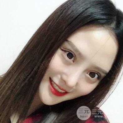 北京美莱赵峻贤隆鼻整形真实案例对比图恢复过程分享