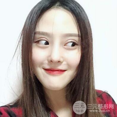 北京美莱赵峻贤隆鼻整形真实案例对比图恢复过程分享