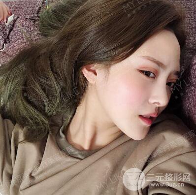北京美莱赵峻贤隆鼻整形真实案例对比图恢复过程分享
