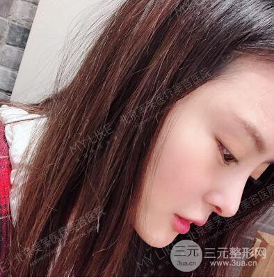 北京美莱赵峻贤隆鼻整形真实案例对比图恢复过程分享
