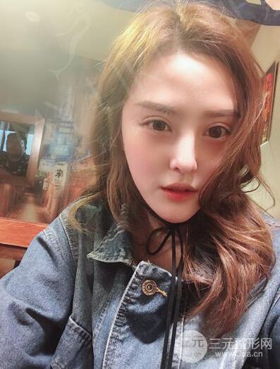 北京美莱赵峻贤隆鼻整形真实案例对比图恢复过程分享