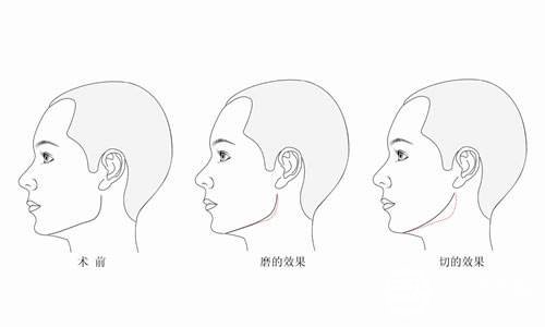 下颌角磨骨手术多少钱 磨骨降低风险吗