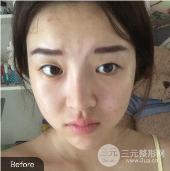 成都天使之翼张劲松切开双眼皮案例前后对比图心情小札