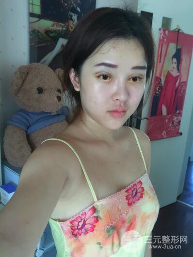 成都天使之翼张劲松切开双眼皮案例前后对比图心情小札