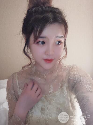 成都天使之翼张劲松切开双眼皮案例前后对比图心情小札