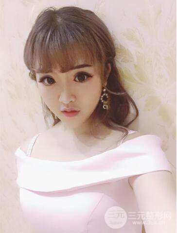 成都天使之翼张劲松切开双眼皮案例前后对比图心情小札