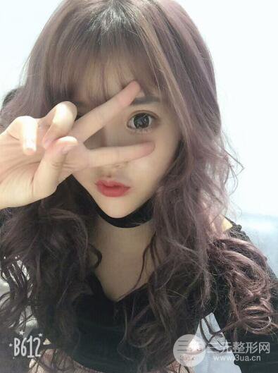 成都天使之翼张劲松切开双眼皮案例前后对比图心情小札