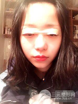 杭州华山连天美高俊明双眼皮案例前后对比图心情分享