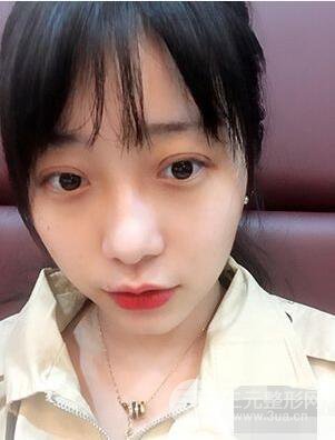 杭州华山连天美高俊明双眼皮案例前后对比图心情分享
