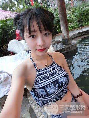 杭州华山连天美高俊明双眼皮案例前后对比图心情分享