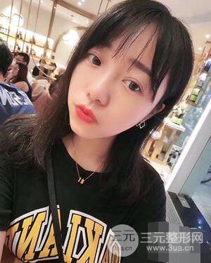 杭州华山连天美高俊明双眼皮案例前后对比图心情分享