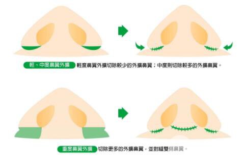 北京好的缩鼻翼手术多少钱 缩鼻翼的方式有哪些